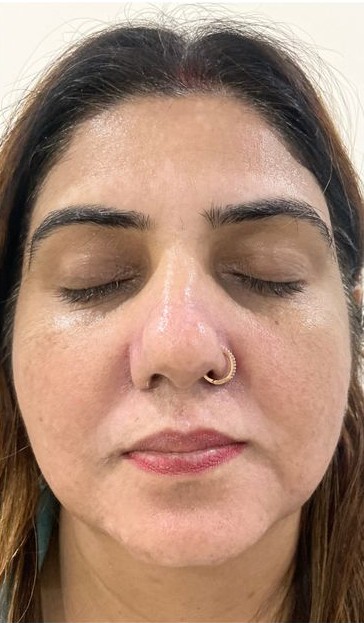 Hydra Facial After treatment at Dexa Clinic