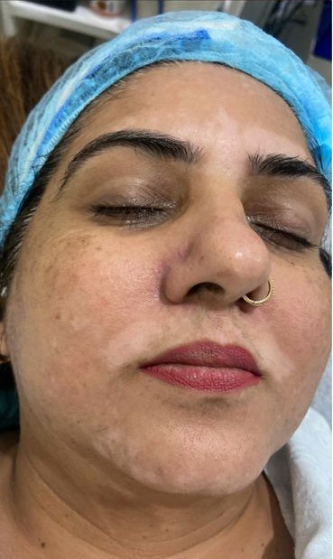 Hydra Facial Before treatment at Dexa Clinic