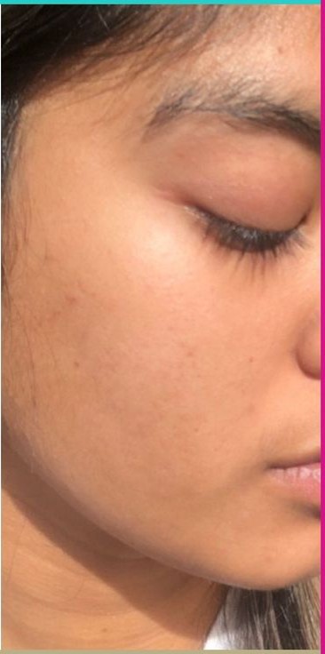 Hydra Facial After Korean glass skin treatment at Dexa Clinic