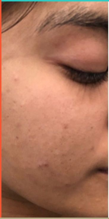 Hydra Facial Before treatment at Dexa Clinic