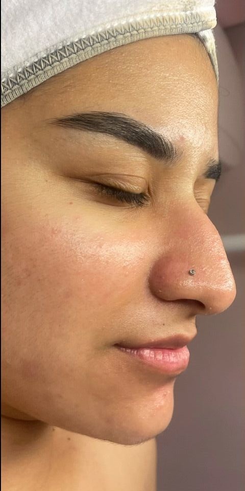 Hydra Facial After treatment at Dexa Clinic