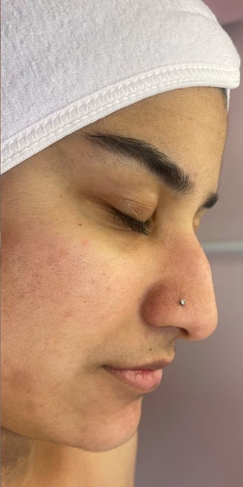 Hydra Facial Before treatment at Dexa Clinic